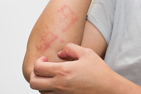 eczema